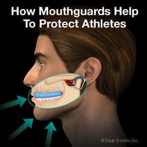 Side profile illustration of a person showing how Adult Mouthguards protect teeth and mouth during sports, with arrows pointing to the mouth and a highlighted area around the jaw and teeth. Text reads: How Mouthguards Help To Protect Athletes.