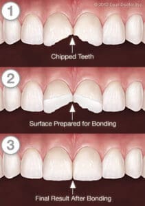 Three-panel dental diagram: 1) Tooth fracture with chipped front teeth, 2) Surface of cracked teeth prepared for bonding, 3) Teeth restored to normal appearance after dental treatment. Each panel is labeled with descriptive text and arrows.