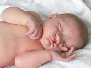 A newborn baby with a cleft lip sleeps peacefully on a white blanket, one arm bent near the face and lips slightly puckered.