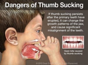 Illustration of Thumb Sucking: A child sucking their thumb reveals internal mouth anatomy. Text explains prolonged Thumb Sucking can cause jaw growth issues and teeth misalignment. Inset shows teeth with an open bite due to Thumb Sucking.