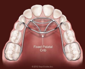 fixed-palatal-crib