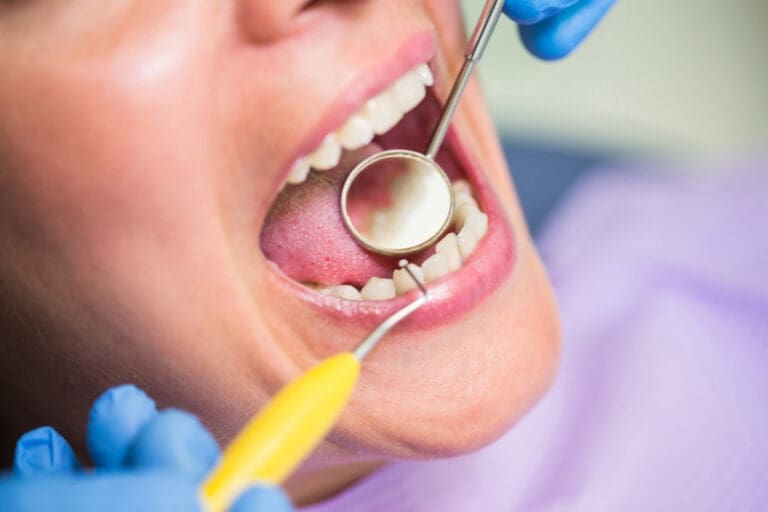 A close-up of a person’s open mouth during a dental exam; a Lansing dentist’s gloved hands hold a dental mirror and probe to inspect the patient’s teeth and gums.